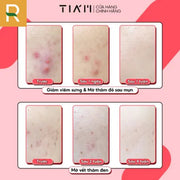 Kem Ch?m M?n TIA'M AC FIGHTING SPOT RX CREAM - TI000003